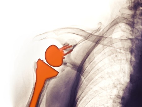 Revision Shoulder Surgery by OrangeCountySurgeons  
